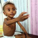 Malnourished Ferial Elias, 2, gestures as she is being weighed at a malnutrition treatment ward at al-Thawra hospital in Hodeidah, Yemen November 3, 2018. Picture taken November 3, 2018. REUTERS/Abduljabbar Zeyad - RC12B1280CC0